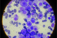 Nádorové buňky pod mikroskopem